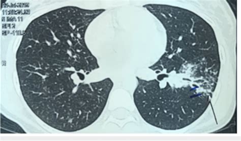 Patchy nodular infiltrates in the left lung along with traction... | Download Scientific Diagram