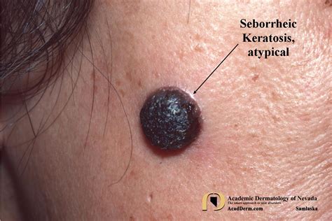 Seborrheic Keratosis: Atypical Forms... - Academic Dermatology of Nevada