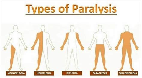 [Infographic] Types of Paralysis | Paralysis, Nursing books, Medical facts