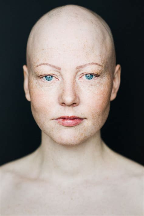 Women With Alopecia Captured In Beautiful Pictures Challenging Gender ...