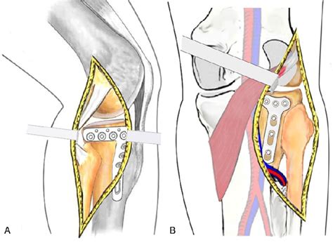 [PDF] Treatment of posterolateral tibial plateau fractures with modified Frosch approach : a ...