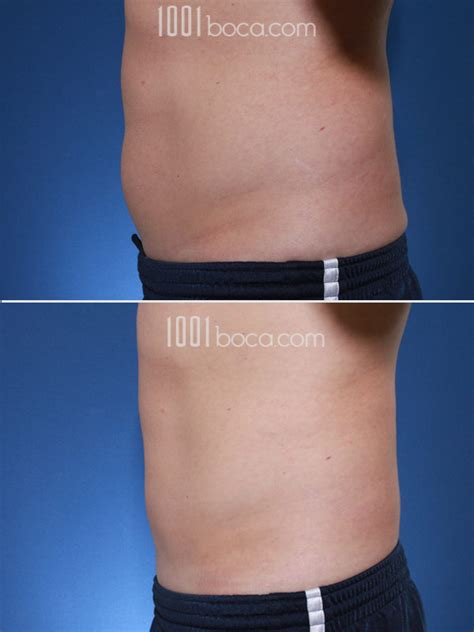 Coolsculpting Before and After Photos