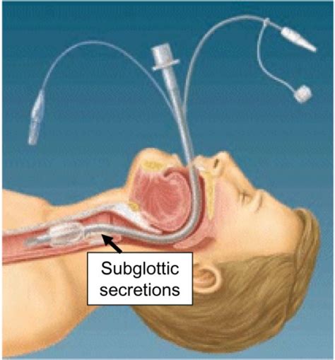 Endotracheal tube with subglottic suction port placed p | Open-i