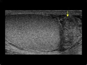 Urinary Tract and male reproductive system | 2.3 Scrotum : Case 2.3.6 Inflammation | Ultrasound ...