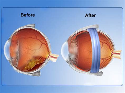 Cataract Surgery Cost in Kochi | Best Squint Treatment in Kochi