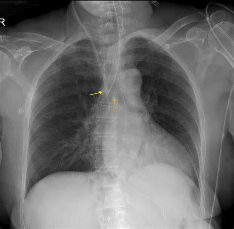 Endotracheal tube at carina - Radiology at St. Vincent's University Hospital