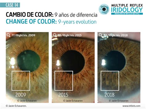 Darkening of the iris color as a result of an eye drop for glaucoma - infoiris