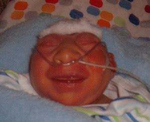 pictures of babies with anencephaly