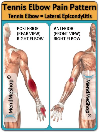 Lateral Epicondylitis Information, aka. Tennis Elbow