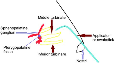 The image shows the location of the sphenopalatine ganglion and the... | Download Scientific Diagram