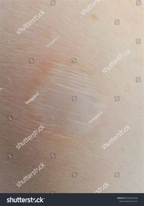 1 Shave Biopsy Scar Images, Stock Photos & Vectors | Shutterstock