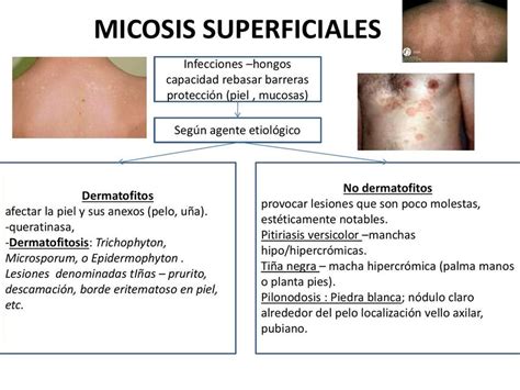 Micosis Superficial | CIENCIAS DE LA SALUD | uDocz