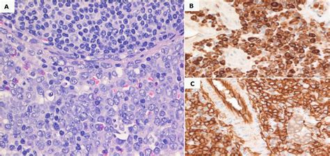 Extramedullary Myeloid Tumor- Lymph node Biopsy