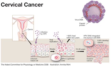 Human Papillomavirus (HPV): The Unseen Leading Cause of Cervical Cancer ...