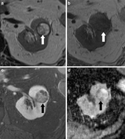 MRI presentation of typical image characteristics of a complex cyst... | Download Scientific Diagram