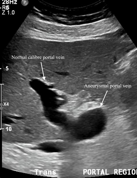 Portal Vein Ultrasound