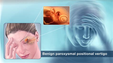 Benign Paroxysmal Positional Vertigo Shown via Medical Animation Still