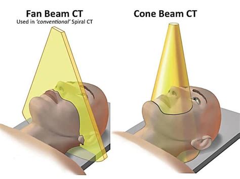 What Is Cone Beam Ct And How Does It Work - The Best Picture Of Beam