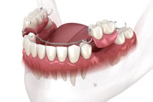 Everything You Should Know About Dental Flippers - Dr Dalesandro