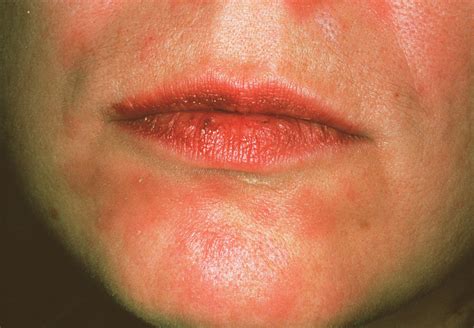 Secondary Syphilis Rash Photograph by Cnri/science Photo Library | Fine Art America