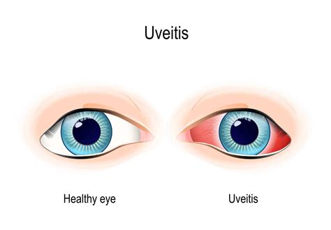 What is Uveitis? - Henderson Eye Care