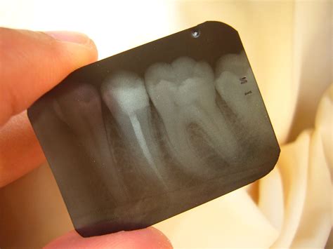 Root Canal Gone Bad: The Complications | Kyrene Family Dentistry AZ Blog