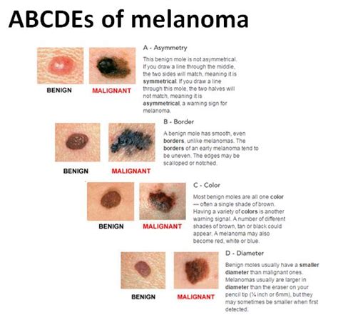 Cancer Malignant Melanoma Causes Symptoms Treatment