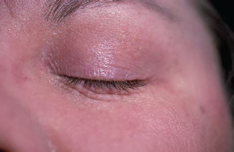 What is the cause of intermittently itchy eyelids? | Consultant360