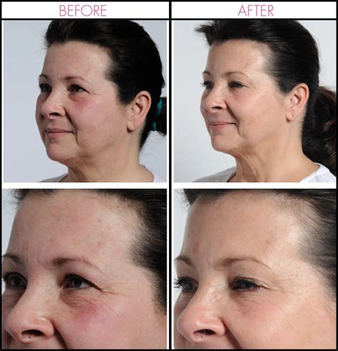 NIRA Anti-Aging Skincare Laser - Skin Renewing/Wrinkle Reduction Laser