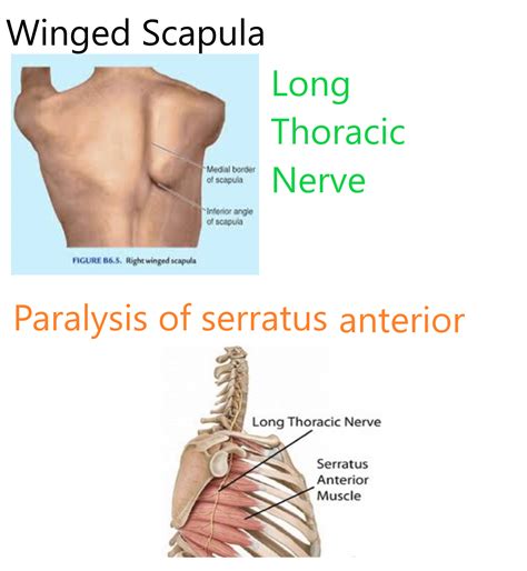 Winged Scapula, Thoracic, Occupational Therapy, Clinic, Muscle, Signs, Occupational Therapist ...