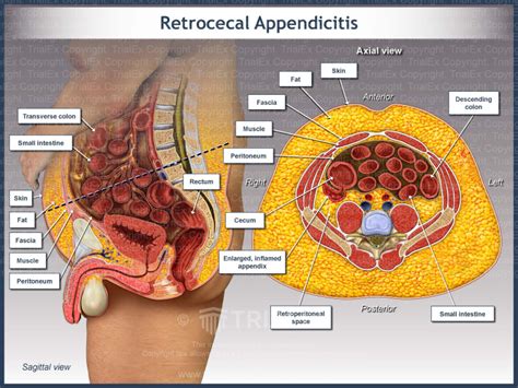 Retrocecal Appendicitis - TrialQuest Inc.