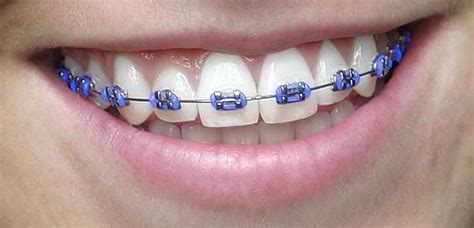 163 best Braces Colors images on Pinterest | Braces colors, Dental and ...