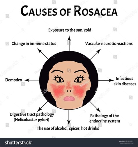 Causes Rosacea Rosacea Awareness Month Infographics: เวกเตอร์สต็อก (ปลอดค่าลิขสิทธิ์) 1661855512 ...