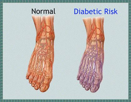 Why Diabetic Neuropathy is a Dangerous Complication of Diabetes - True Med Cost