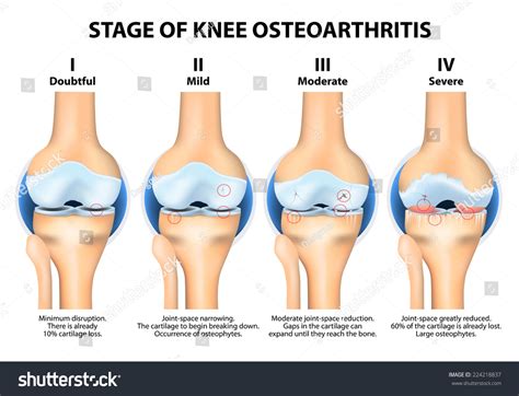 Stages Of Knee Osteoarthritis (Oa) Stock Vector Illustration 224218837 : Shutterstock