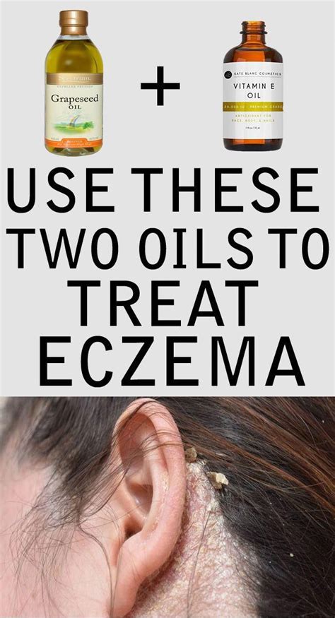 #eczema #scalp #vitaminE #grapeseedoil apply these two oils available in your home on eczema ...