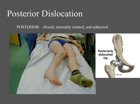 Hip dislocation