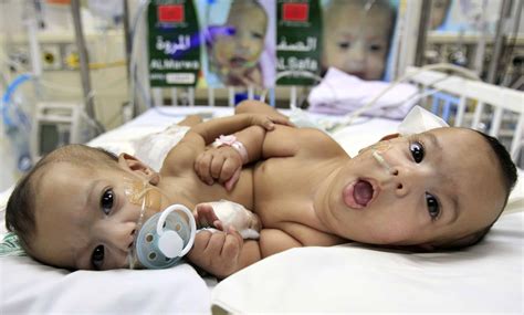 Conjoined twins born at San José hospital