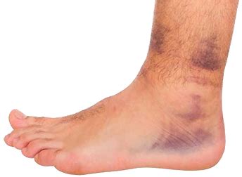 Stone Bruise | Causes & Treatment | #1 Florida Foot & Ankle