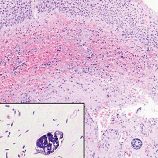 Photomicrography of a cervical conization specimen showing high-grade... | Download Scientific ...