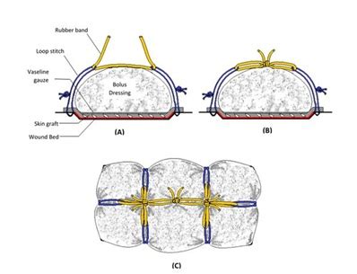 Simple Loop Stitch Tie over Technique for Skin Graft