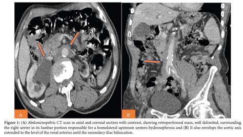 Retroperitoneal fibrosis | International Journal of Clinical & Medical Images