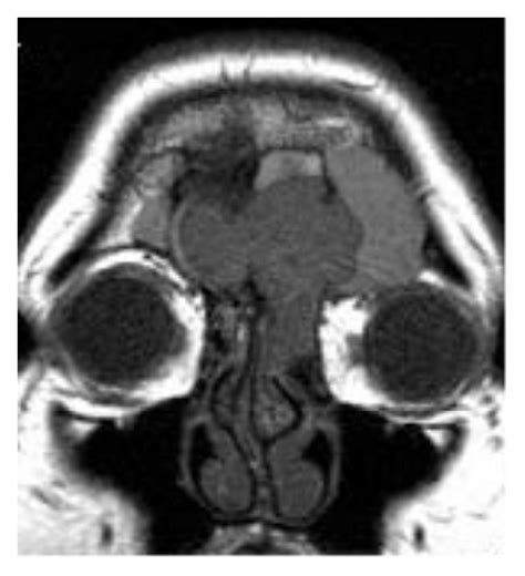 ((a) and (b)) Preoperative coronal MRI images showing the tumor’s... | Download Scientific Diagram