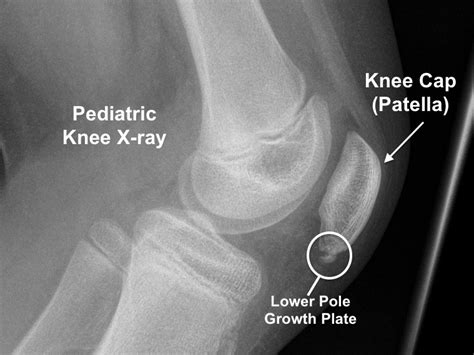 Sinding-Larsen-Johansson Syndrome (Knee)