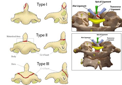 Odontoid Fracture - Spine - Orthobullets