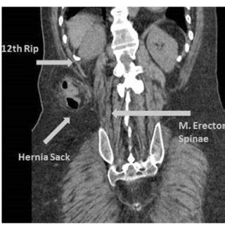 Schematic display of the superior lumbar triangle. The triangle is ...