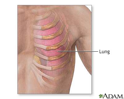 Costochondritis Symptoms, Doctors, Treatments, Advances & More | MediFind