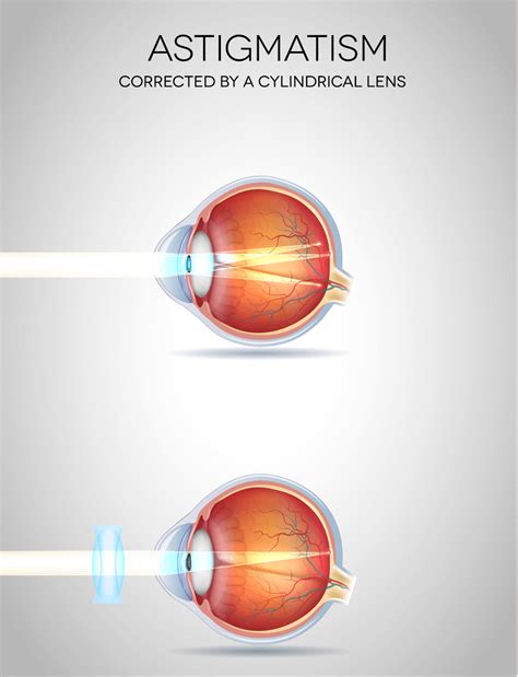 Astigmatism - New Jersey Eye Center