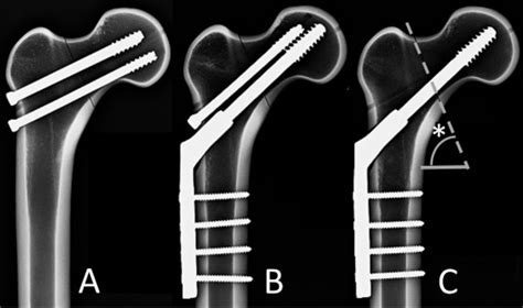 A sliding hip screw augmented with 2 screws is biomechanically similar to an inverted triad of ...