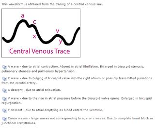 Central venous pressure trace – Artofit